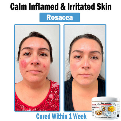 TO𝑫A𝐇OF®✔ 𝑩𝒆𝐞 𝑽𝐞𝒏𝒐𝒎 𝑴𝒖𝒍𝒕𝒊-𝑺𝒚𝒎𝒑𝒕𝒐𝒎 𝑺𝒌𝒊𝒏 𝑻𝒓𝐞𝒂𝒕𝒎𝒆𝒏𝒕 𝑪𝒓𝐞𝒂𝒎 (👨‍⚕𝑵𝑷𝑭 𝑹𝑬𝑪𝑶𝑴𝑴𝑬𝑵𝑫𝑺)🐝
