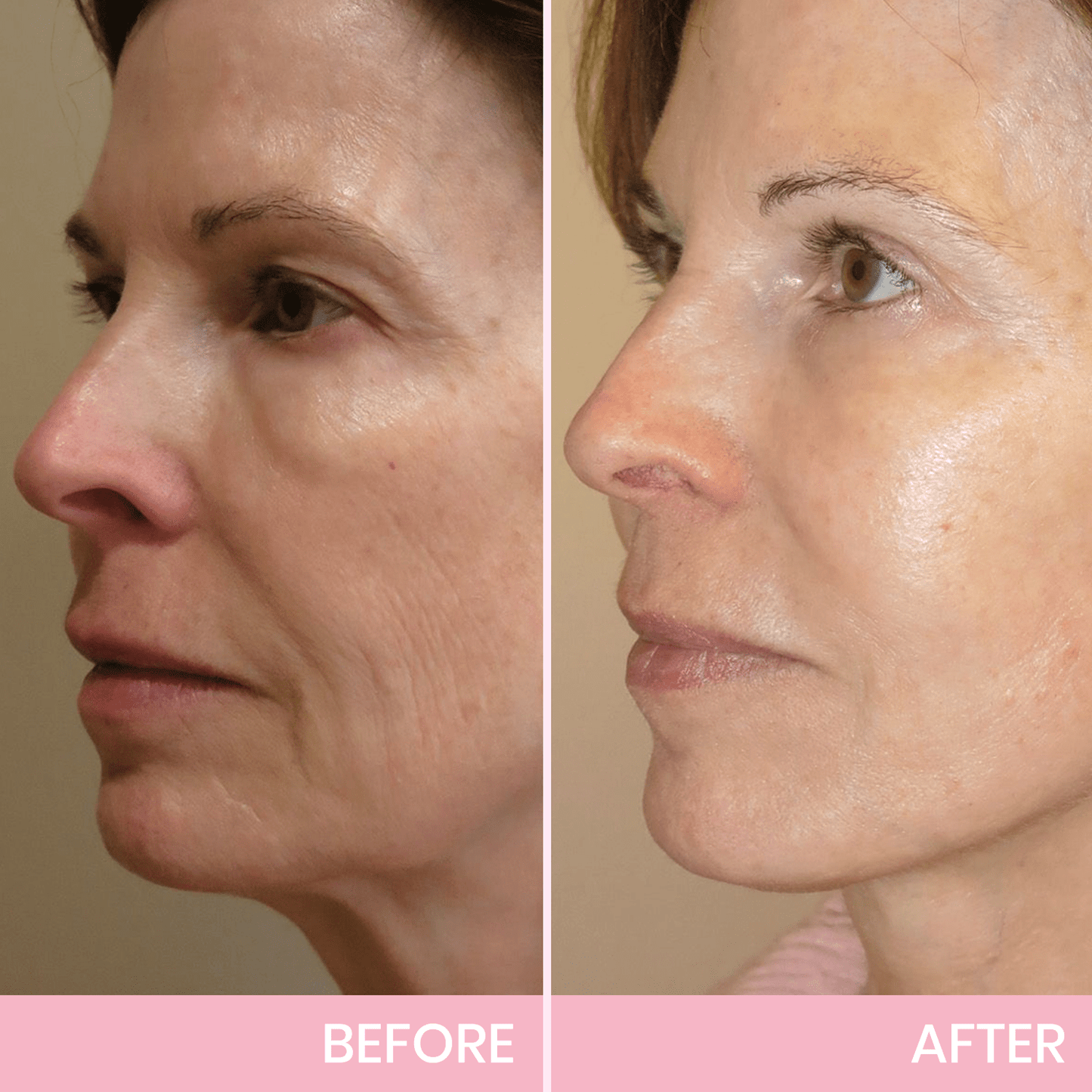 V-Face Lifting Invisible Adhesive Tape 10✔️