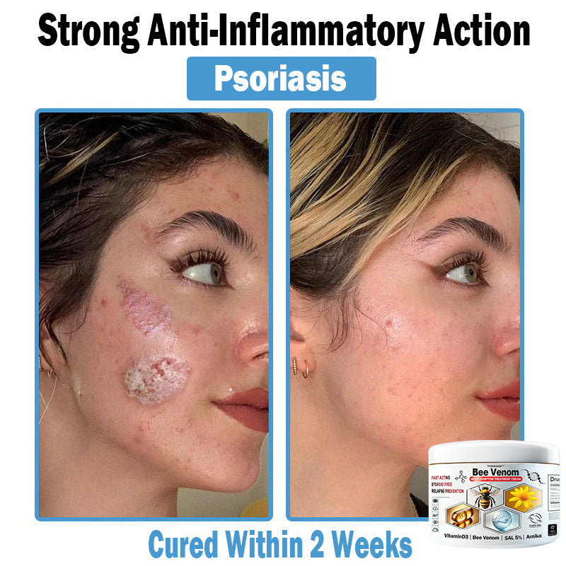 TO𝑫A𝐇OF®✔ 𝑩𝒆𝐞 𝑽𝐞𝒏𝒐𝒎 𝑴𝒖𝒍𝒕𝒊-𝑺𝒚𝒎𝒑𝒕𝒐𝒎 𝑺𝒌𝒊𝒏 𝑻𝒓𝐞𝒂𝒕𝒎𝒆𝒏𝒕 𝑪𝒓𝐞𝒂𝒎 (👨‍⚕𝑵𝑷𝑭 𝑹𝑬𝑪𝑶𝑴𝑴𝑬𝑵𝑫𝑺)🐝