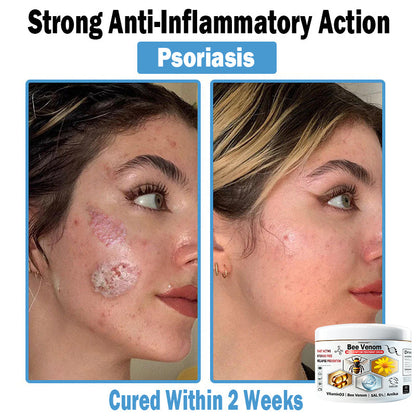 TO𝑫A𝐇OF®✔ 𝑩𝒆𝐞 𝑽𝐞𝒏𝒐𝒎 𝑴𝒖𝒍𝒕𝒊-𝑺𝒚𝒎𝒑𝒕𝒐𝒎 𝑺𝒌𝒊𝒏 𝑻𝒓𝐞𝒂𝒕𝒎𝒆𝒏𝒕 𝑪𝒓𝐞𝒂𝒎 (👨‍⚕𝑵𝑷𝑭 𝑹𝑬𝑪𝑶𝑴𝑴𝑬𝑵𝑫𝑺)🐝